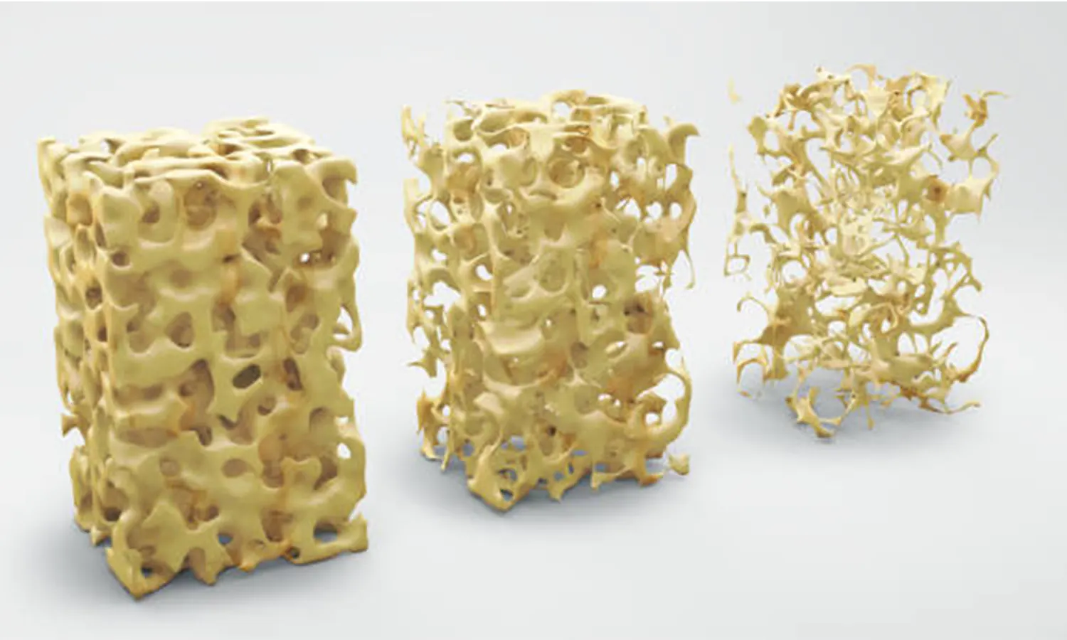 Cara Menghindari Osteoporosis pada Tulang Manusia