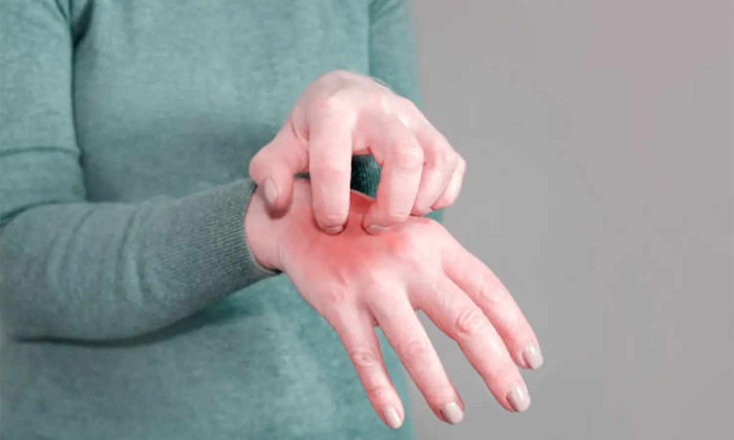 SCABIES : Pengertian, Penyebab Serta Cara Mengobati