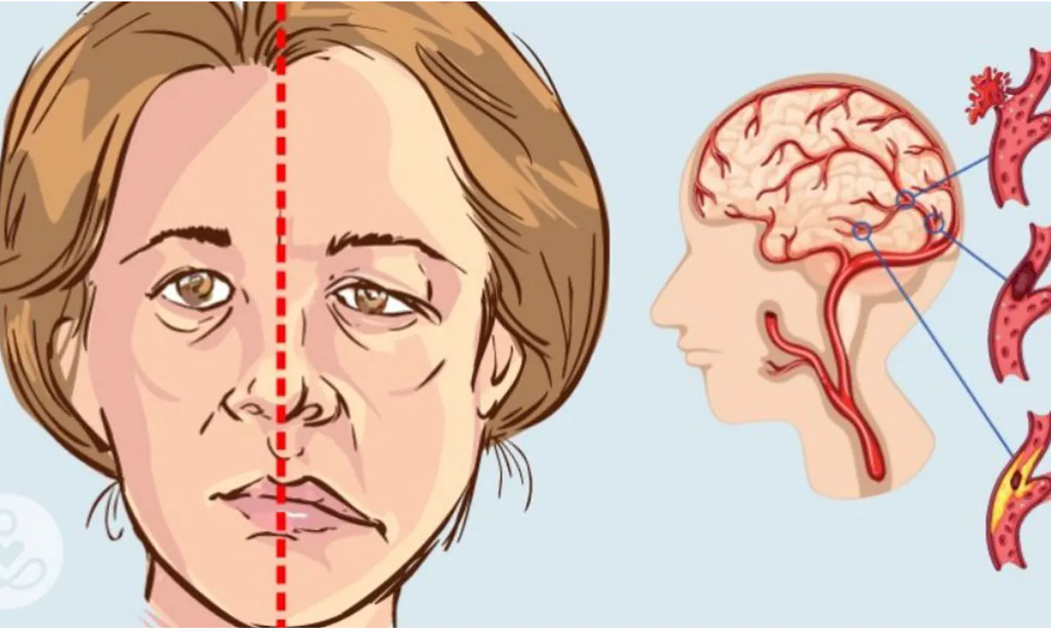 STROKE : Gejala dan Cara Mengatasi