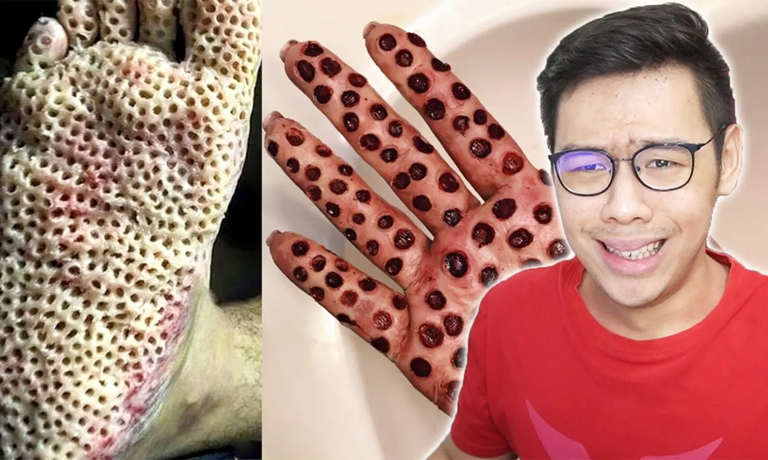 Trypophobia  Pengertian, Gejala, Cara Mengatasi