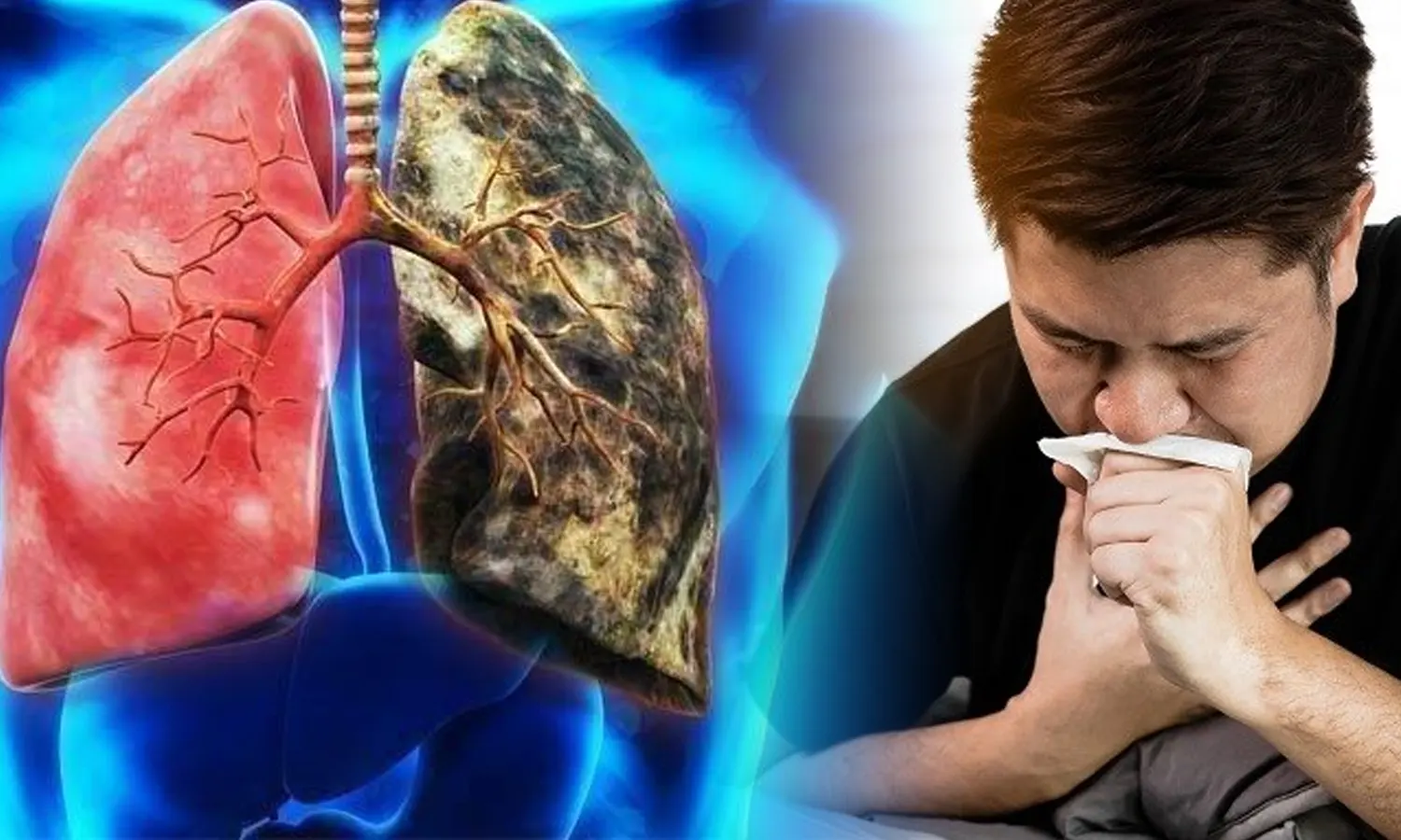 Apa Itu Penyakit Bronkiektasis? Kenali Gejala, Penyebab dan Cara Mengobatinya