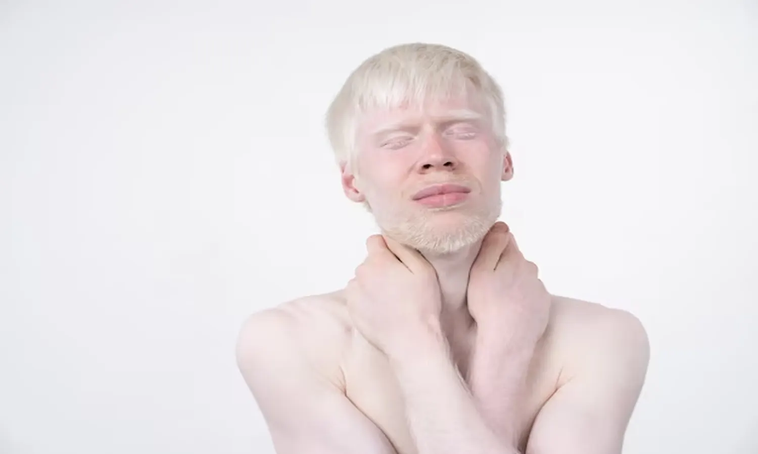 Albino Adalah: Pengertian, Ciri-ciri, Gejala, Penyebab, dan Penanganannya