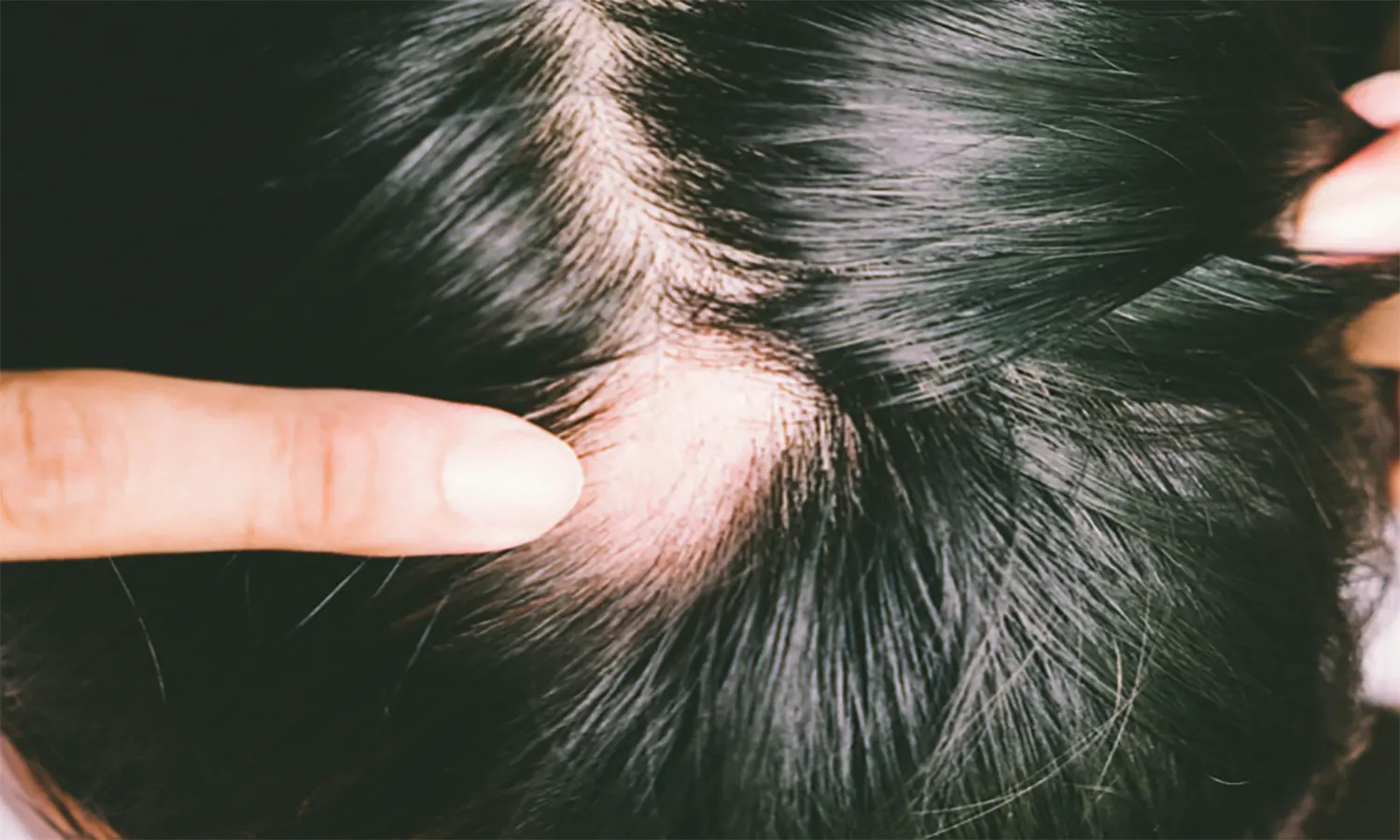 Apa itu Alopecia Areta? Kenali Penyebab dan Faktor Risikonya