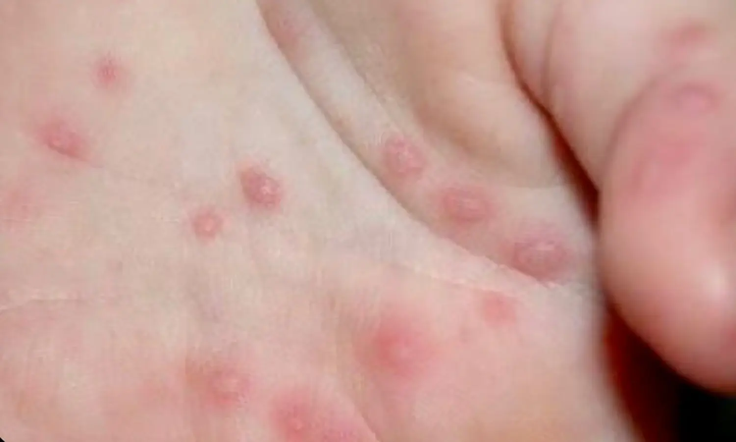 Sebabkan Demam dan Bintik Merah, Ini Penjelasan Dokter soal Flu Singapura!