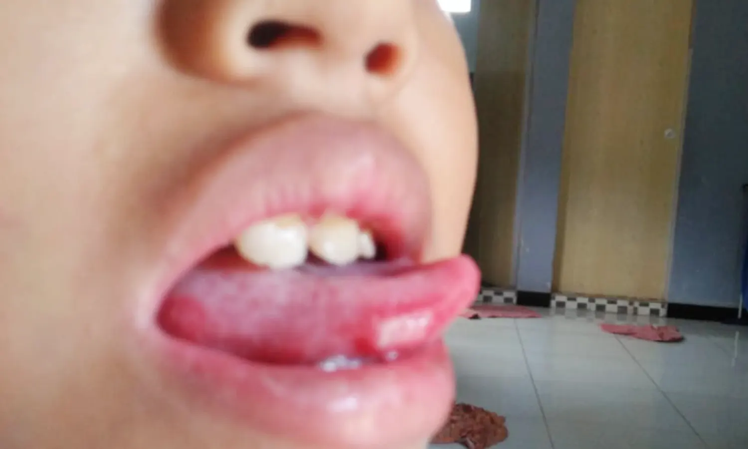 Dugaan Temuan Virus Flu Singapura di Pematang Siantar, Serang Anak-anak