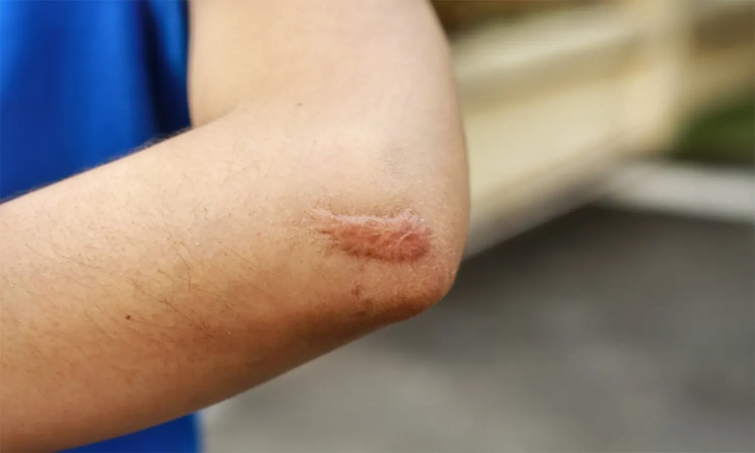 Mengenal Penyebab dan Cara Menghilangkan Keloid pada Tubuh
