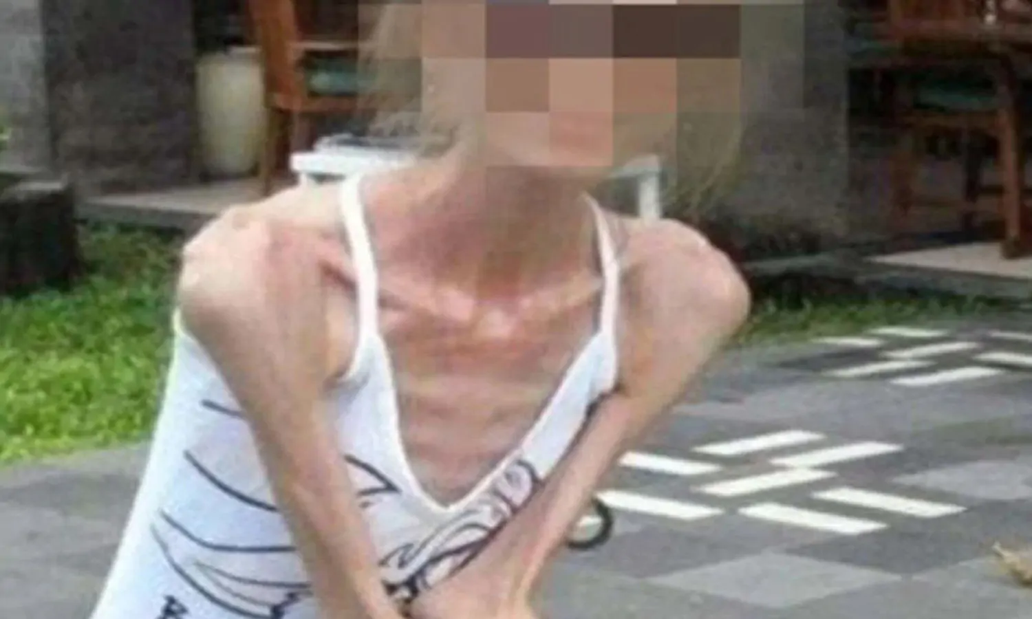 Terobsesi punya Tubuh Langsing, Wanita di China jadi Kerempeng Berbobot 25 Kg