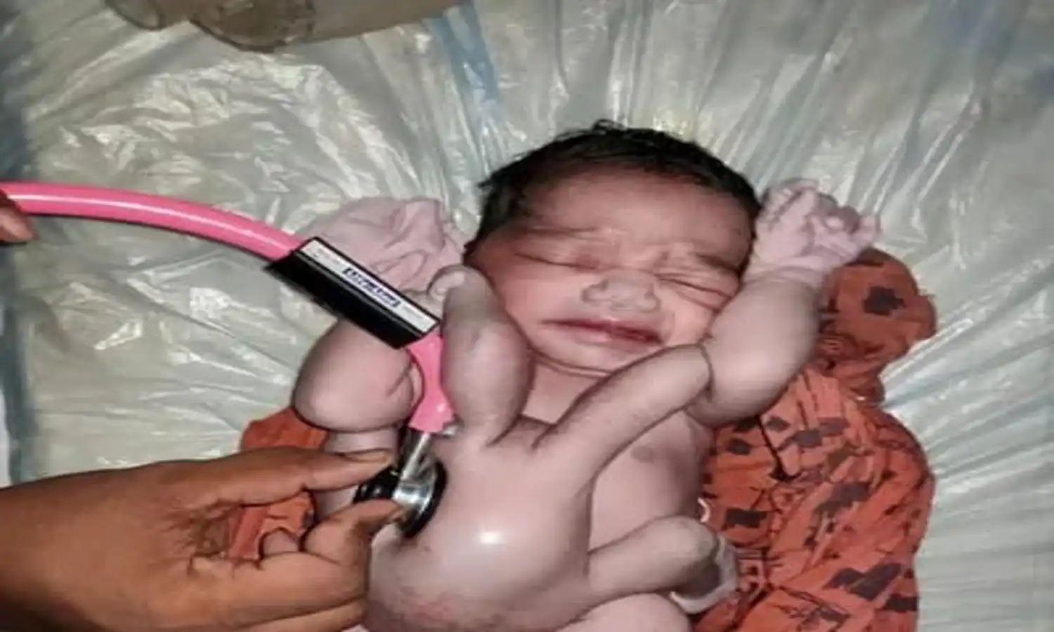 Bayi Bertangan dan Berkaki Empat Titisan Dewi Lakhsmi Lahir di India