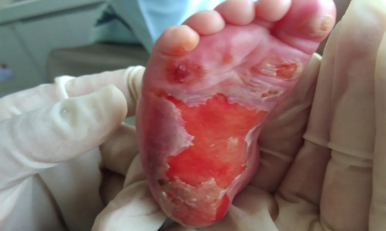 Kaki Bayi di Medan Melepuh Usai Cek Stunting