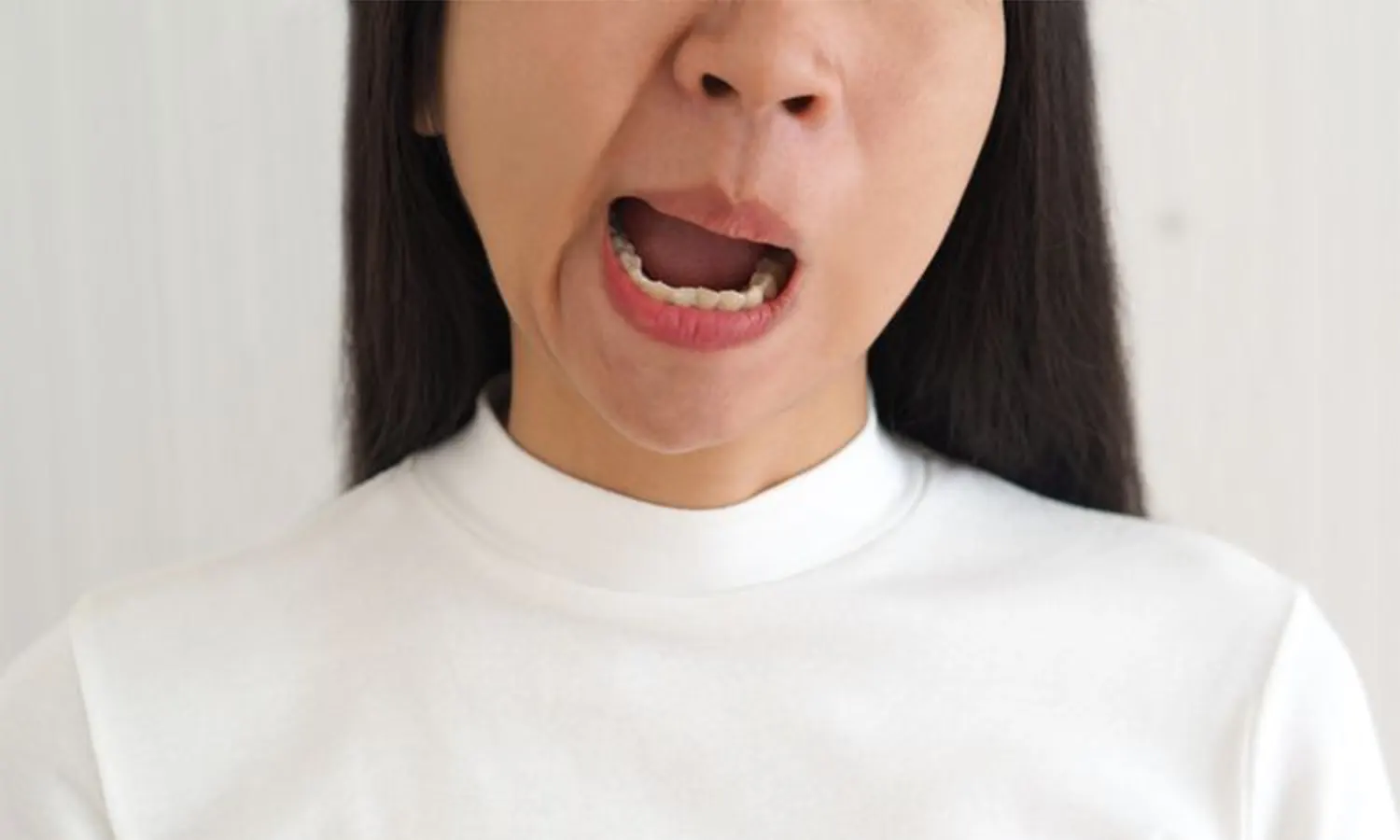 Bell's Palsy : Gejala, Penyebab, Cara Mengatasi, Hingga Cara Mencegah
