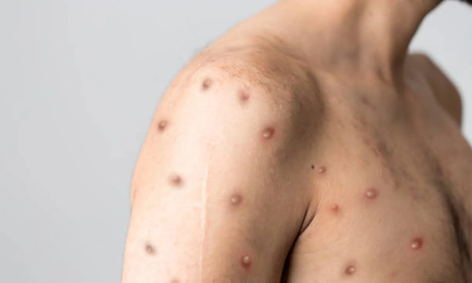 Kasus Monkeypox Kembali Ditemukan di Jakarta, 7 Orang Dinyatakan Positif 