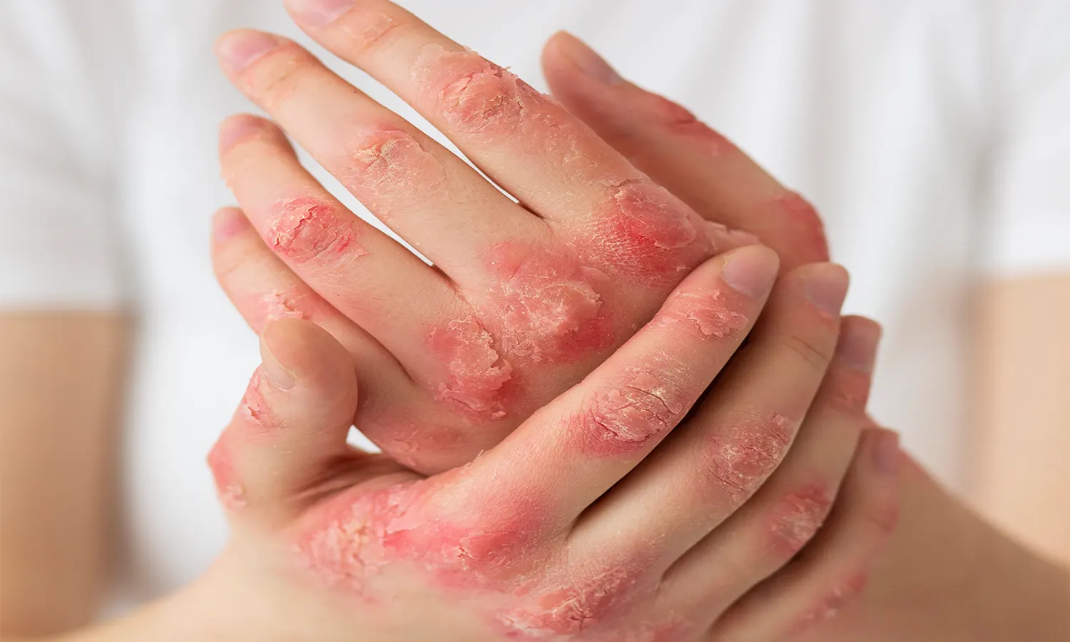 Apakah Psoriasis Berbahaya? Kenali Jenis, Gejala, Penyebab, Pengobatan, dan Cara Perawatan di Rumah