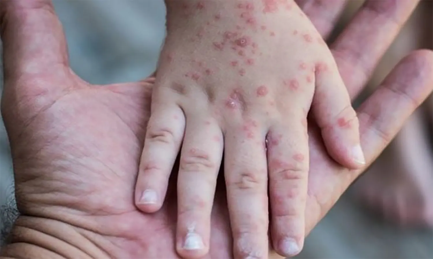 Sering Menyerang Anak, Kenali Penyebab dan Gejala Flu Singapura