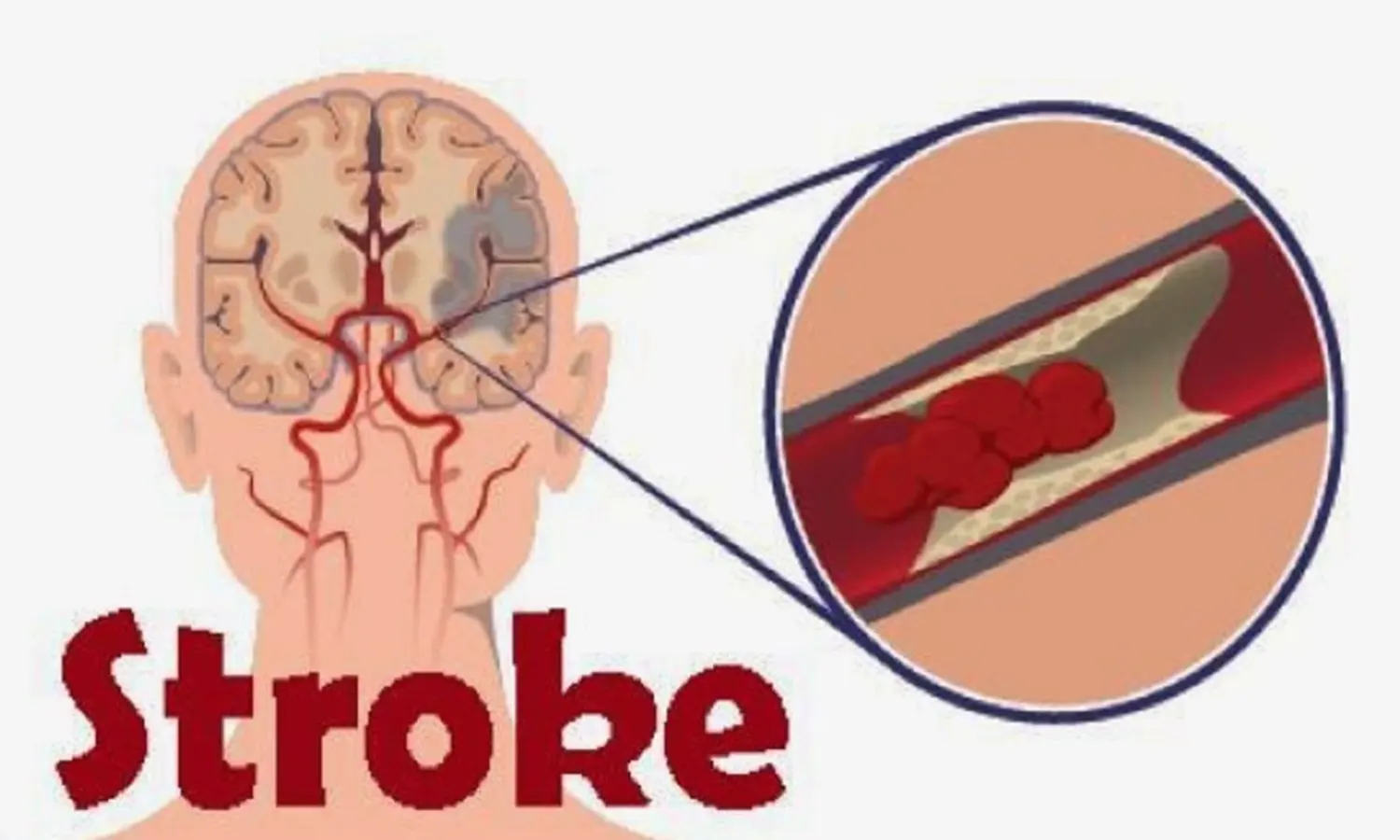 Catat! 90 Persen Kasus Stroke Bisa Dicegah