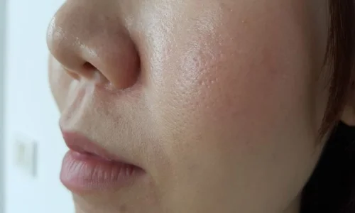 Cara Mengatasi Kulit Berminyak